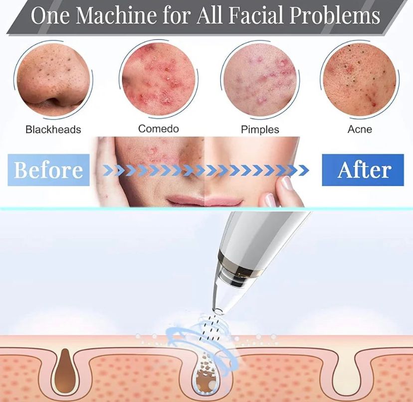 Derma Suction Blackhead Removal Machine – 4 in 1