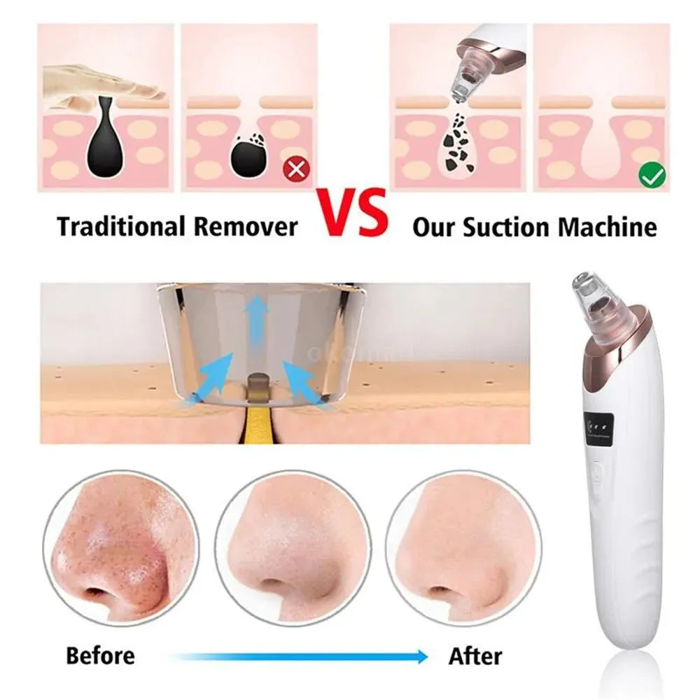 Derma Suction Blackhead Removal Machine – 4 in 1